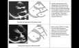 Cuantificación ecocardiográfica de las cámaras derechas