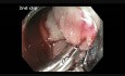 Ciego - resección de un pólipo pedunculado grande