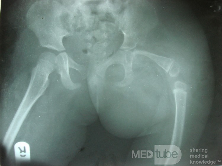 Deficiencia femoral focal proximal