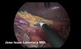Procedimiento laparoscópico de Hartmann
