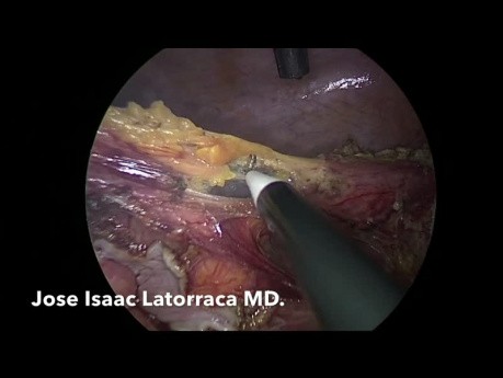 Procedimiento laparoscópico de Hartmann