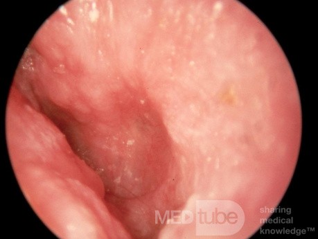 Otitis externa crónica con miringitis crónica