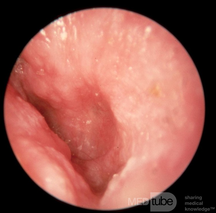 Otitis externa crónica con miringitis crónica