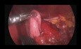 Fundoplicatura y miotomía de Heller