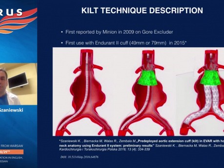 Técnica Kilt en Aneurisma de Aorta Abdominal (AAA) de Cuello Hostil con el Apoyo de Endoanclajes - Detalles de una Técnica y Reporte de Caso