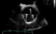 Ecocardiograma transesofágico