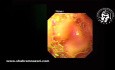 Endoscopia para hernia hiatal deslizante de gran tamaño con estómago intratorácico