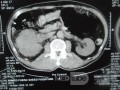 Carcinoma de células renales derecho