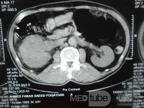 Carcinoma de células renales derecho