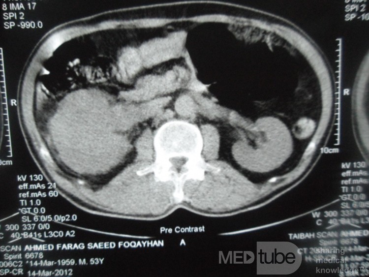 Carcinoma de células renales derecho