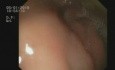 Fístula del bulbo duodenal - complicación de úlceras