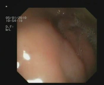 Fístula del bulbo duodenal - complicación de úlceras