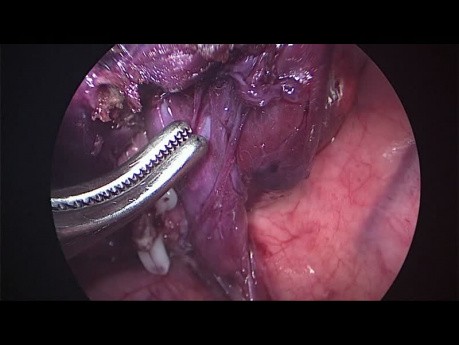 Segmentectomía anatómica por cirugía toracoscópica asistida por vídeo (CTAV)