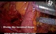 Hemicolectomía derecha extendida laparoscópica