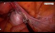 Salpingooforectomía Bilateral para Masa Ovárica con Transvaginal Extracción