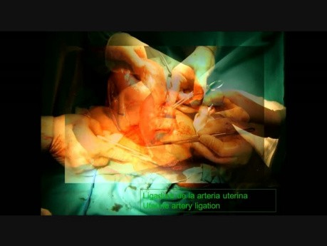 Ligadura de la arteria uterina durante una cesárea.