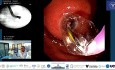 Sin ecoendoscopia, hipertensión portal y obstrucción gástrica urgente. No hay problema.