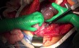 Cáncer de ovario - citorreducción radical