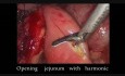 Pancreatoyeyunostomia laparoscópica