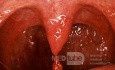 Papiloma benigno de la úvula