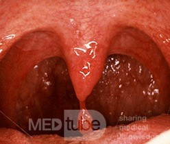 papiloma uvula benigno