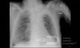 Radiografía de tórax - COVID-19 (3)