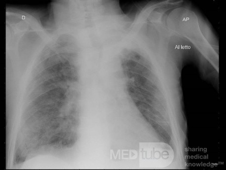 Radiografía de tórax - COVID-19 (3)
