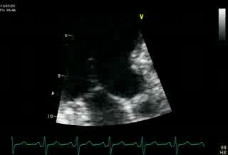 Movimiento Anterior Sistólico (MAS) Mitral (Cuerdas con movimiento anterior sistólico incompleto)