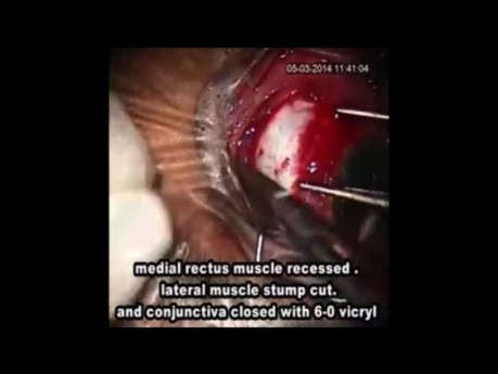 Manejo de la pérdida de músculo durante la cirugía de estrabismo