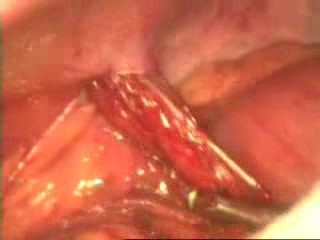 Laparoscopia por traumatismo abdominal penetrante con prolapso