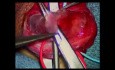 Varicocelectomía subinguinal