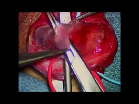 Varicocelectomía subinguinal