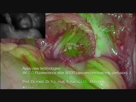 Anastomosis rectal con verde indocianina