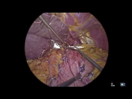 Tutorial de la aplicación de fundoplicatura de geometría