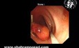 Cierre con clip para prevenir eventos adversos después de la resección endoscópica de la mucosa (REM)