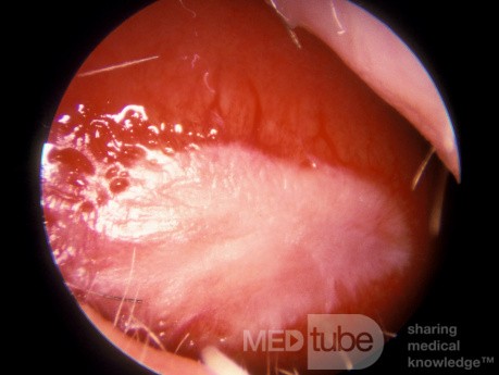 Hiperqueratosis del tabique nasal