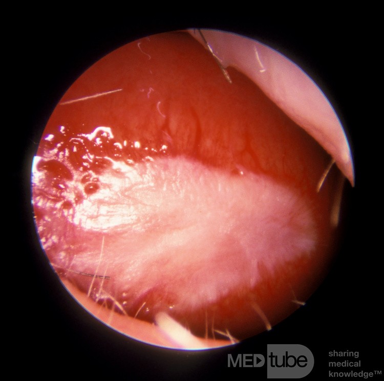 Hiperqueratosis del tabique nasal