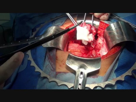 Histerectomía - método abierto con el uso de herramientas eléctricas