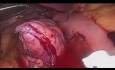 Bypass gástrico de una anastomosis