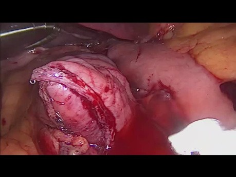 Bypass gástrico de una anastomosis