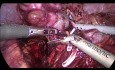 Nefrectomia parcial laparoscopica izquierda por quistes complicados