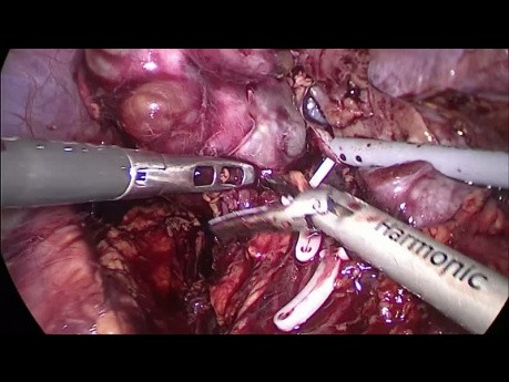 Nefrectomia parcial laparoscopica izquierda por quistes complicados