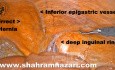 Puntos de referencia para la reparación laparoscópica de hernias
