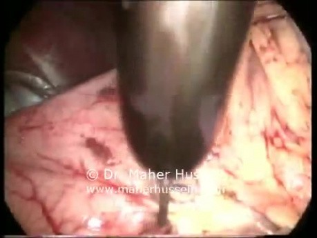 Billroth II - abordaje laparoscópico