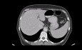 Presentaciones de casos: #1 Gastrectomía total para cáncer gástrico avanzado #2 Hemicolectomía derecha para cáncer de colon derecho localmente invasivo