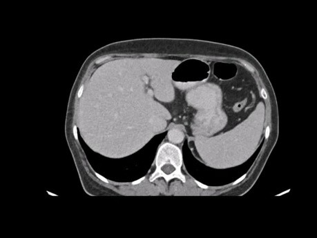 Presentaciones de casos: #1 Gastrectomía total para cáncer gástrico avanzado #2 Hemicolectomía derecha para cáncer de colon derecho localmente invasivo