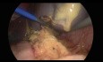 Esplenectomía laparoscópica
