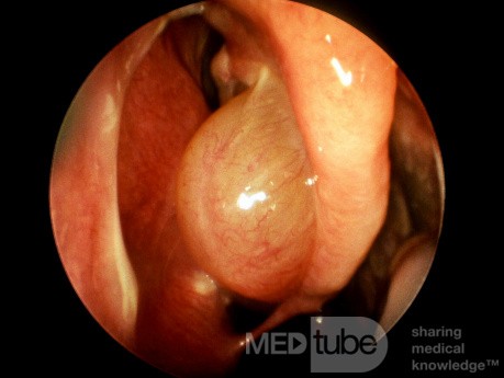 Pólipo nasal que surge del cornete medio