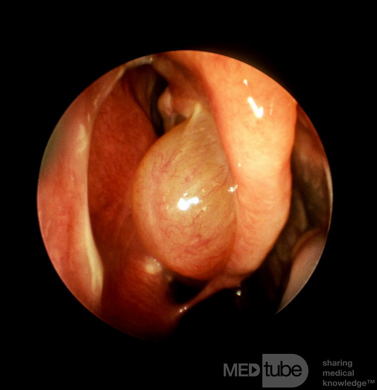 Pólipo nasal que surge del cornete medio
