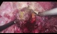 Resección hepática toracoscópica de lesión localizada en el segmento 7 